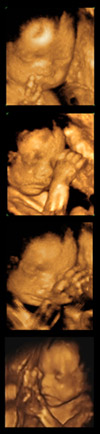 3D/4D Ultrasound image